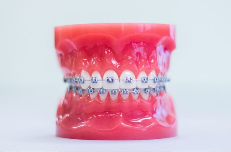 metal braces on plastic typodont